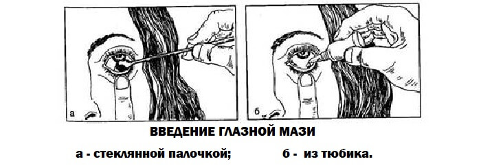 Закладывание мази в глаз