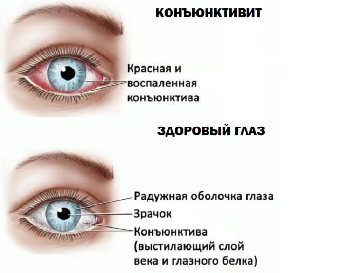 Здоровый глаз и конъюнктивит