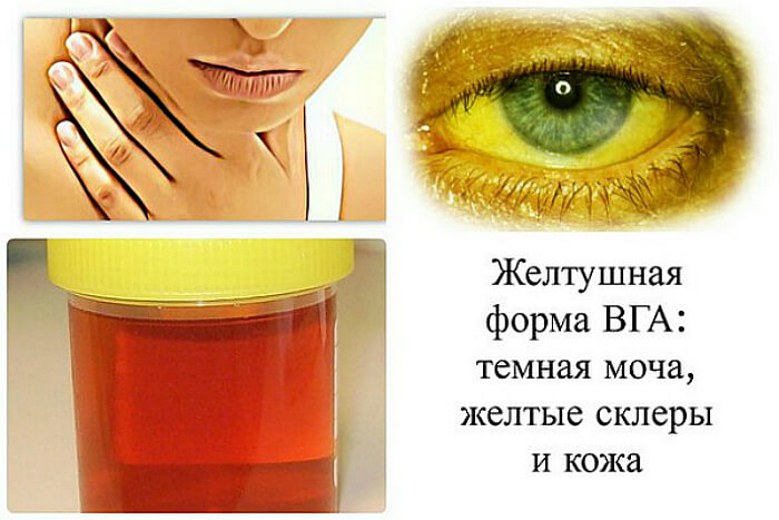 Желтушная болезнь