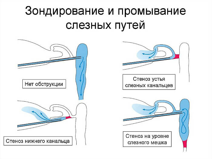 Зондирование при дакриоцистите